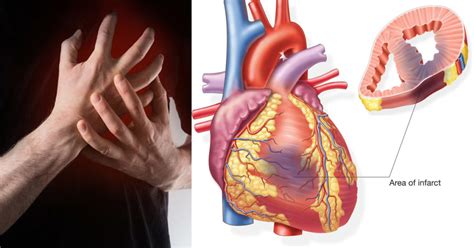 Myocardial Infarction (Heart Attack) | Top Neuro Docs