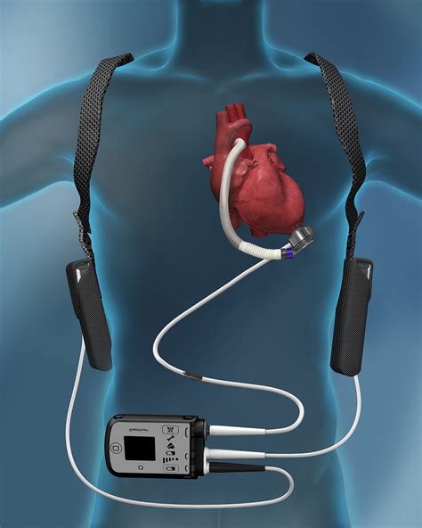 Left Ventricular Assist Device | Lovelace Health System in New Mexico