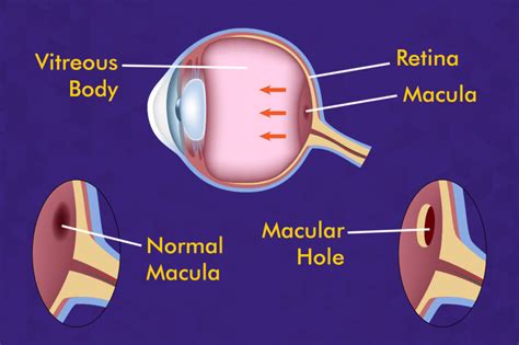 Macular Hole(Retinal Hole) : Symptoms ,Causes and Treatments | Centre ...