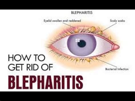 How to Get Rid of Blepharitis Naturally at Home || Home Remedies for ...