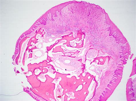 Peripheral Ossifying Fibroma Histology