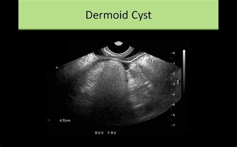 dermoid | Ultrasound sonography, Ultrasound school, Ultrasound technician