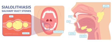 Sialolithiasis - Medical Exam Prep