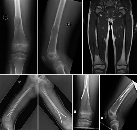 Evidence-Based Treatment of Simple Bone Cyst | Musculoskeletal Key