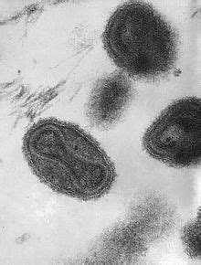 Smallpox - Wikipedia