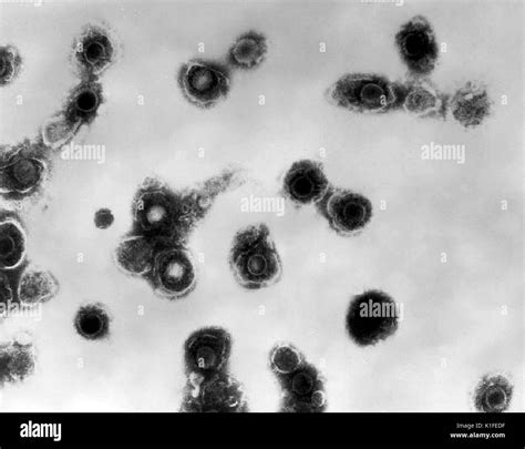 Transmission electron micrograph of varicella-zoster virions from vesicle fluid of patient with ...