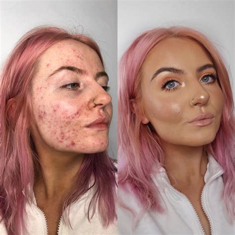 This foundation is going viral after cystic acne sufferer shares her amazing before-and-after ...