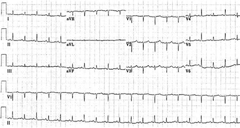 Low QRS Voltage • LITFL • ECG Library Diagnosis