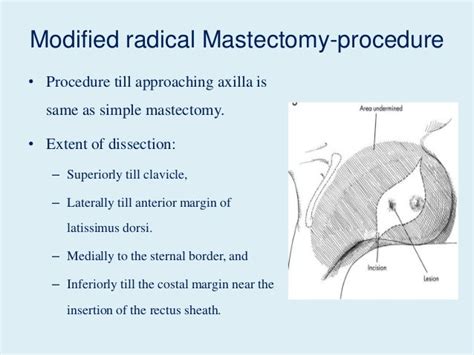 Mastectomy Anatomy