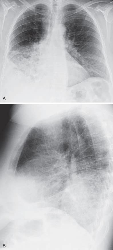 Consolidation | Radiology Key