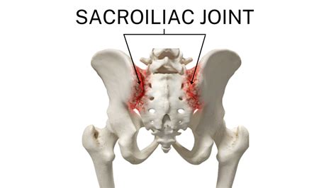 Sacroiliac Joint Dysfunction