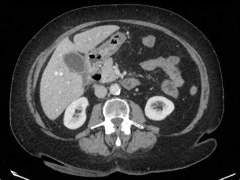 Perforated duodenal diverticulum, a rare complication of a common pathology: A seven-patient ...