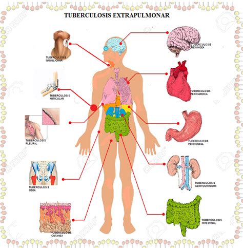 TUBERCULOSIS LATENTE Y LETAL: TUBERCULOSIS EXTRAPULMONAR