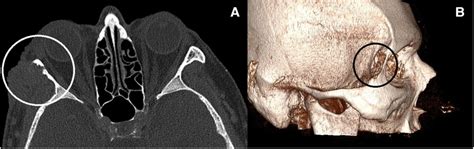 (A,B) Orbital CT scan—tumor eroding the bone. | Download Scientific Diagram