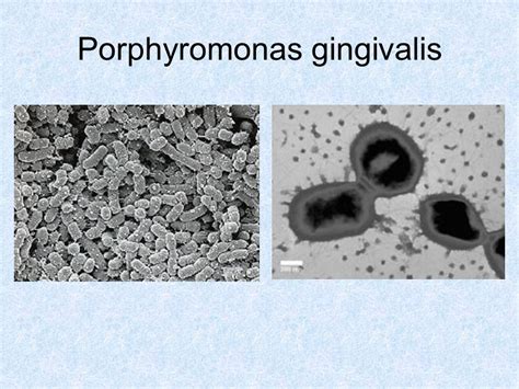 Porphyromonas gingivalis antibiotic treatment