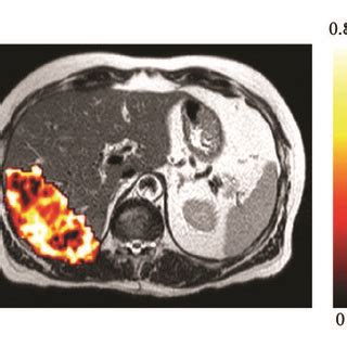 Perfusion monitoring using dynamic contrast-enhanced (DCE) MRI in liver... | Download Scientific ...