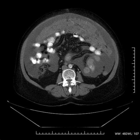 Omental cake | Radiology Case | Radiopaedia.org | Radiology, Cancer, Colon cancer