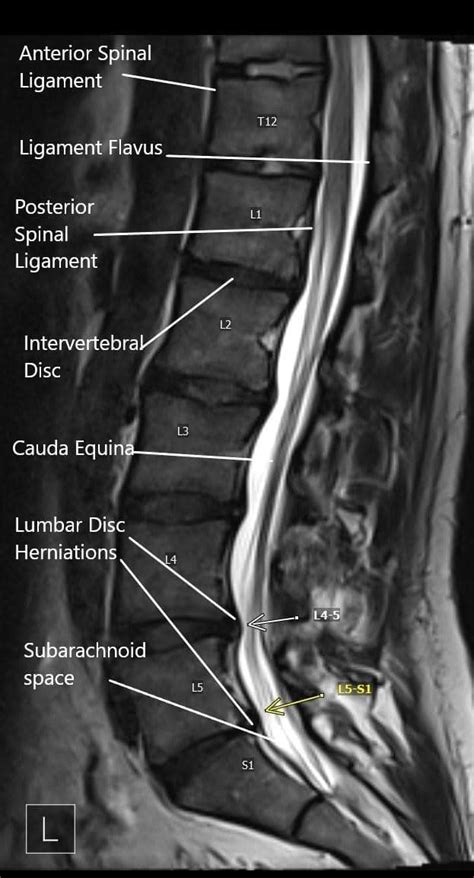 Sciatica Nerve (Lumbar Radiculopathy) - Complete Orthopedics