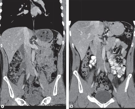 a Patient #3, left-sided testicular seminoma. Abdominal CT reveals ...