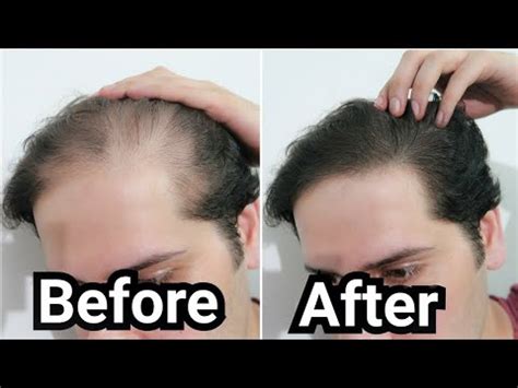 How I Grew Back my Hair with Rosemary Oil (My Results w/ Pictures ...