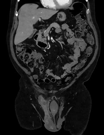 Spermatic cord liposarcoma | Radiology Case | Radiopaedia.org