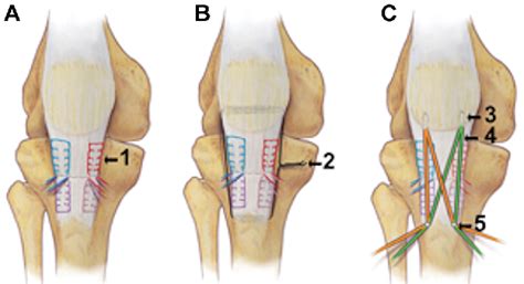 Table 1 from Patellar Tendon Repair Augmentation With a Knotless Suture Anchor Internal Brace: A ...