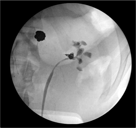 Left Retrograde Pyelogram with Resolved Fistula Left retrograde ...