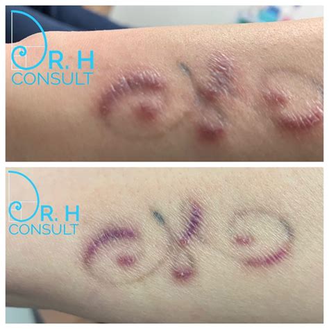 Hypertrophic Scar Treatment / Removal London | Dr H Consult