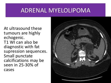 Adrenal Adenoma Radiology