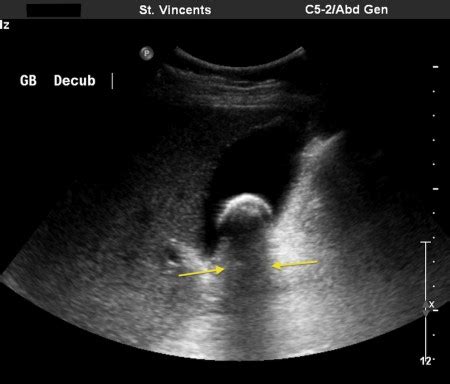 Gallstone – ultrasound - Radiology at St. Vincent's University Hospital