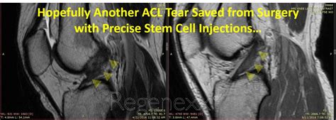 Another ACL Stem Cell Injection Procedure Result - Regenexx®