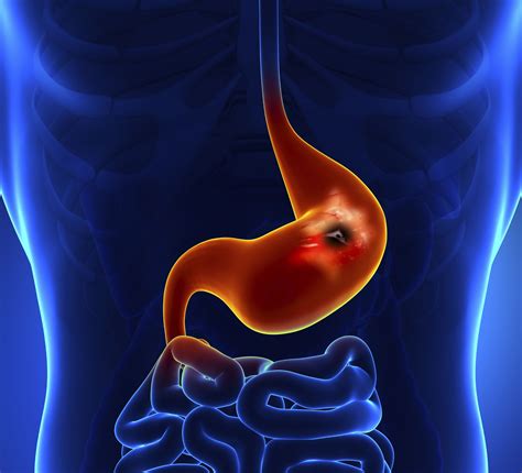 Gastric MALT Lymphoma - Treatment Options and Prognosis