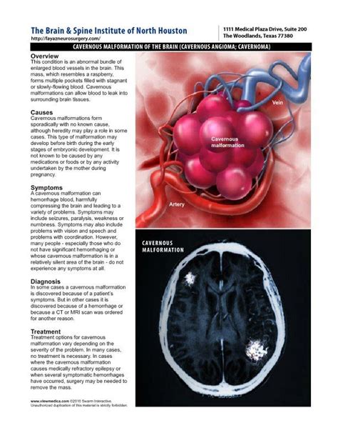 cavernous malformation - Google 검색 | Brain surgery, Brain tissue, Brain ...