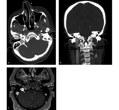 8 High-Riding Jugular Bulb | Radiology Key