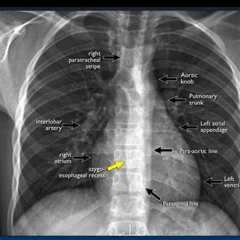 Transvaginal ultrasound (TVS Ultrasound) Procedure - Ganesh Diagnostic