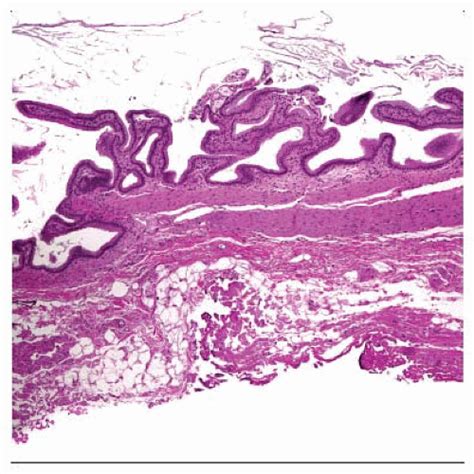 Cholecystitis Histology