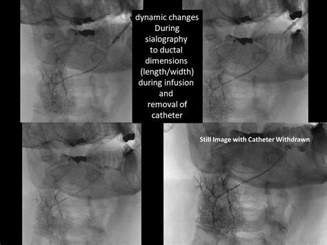 Submandibular Sialogram with Stricture Showing Dynamic Changes to Duct ...