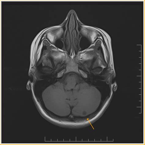 Benign Cerebellar Cyst: MRI - Sumer's Radiology Blog