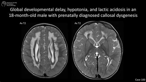 Global developmental delay, hypotonia, and lactic acidosis in an 18-month-old male with ...