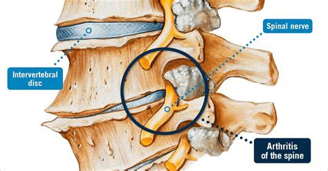 Arthritis of the Spine - USA Spine Care - Laser Spine Surgery