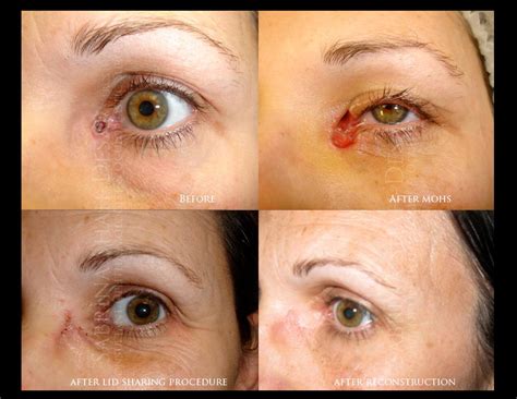 Mohs Surgery Skin Cancer Surgery Skin Cancer Treatment Oculoplastic Surgeon in UK