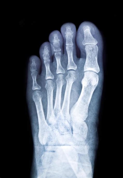 What is a Metatarsal Stress Fracture? (with pictures)