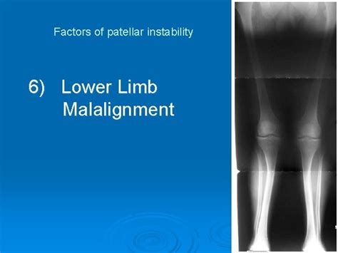 Surgical Treatment Of Habitual Dislocation Of The Patella