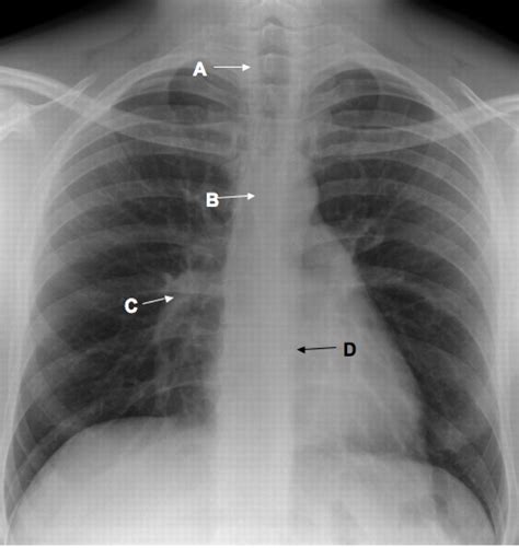 Chest radiograph (posterior anterior view) | The BMJ