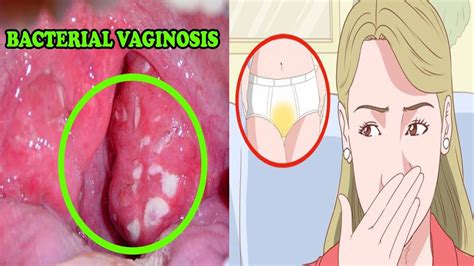 bacterial vaginosis : home remedies for bacterial vaginosis - how to get rid of bacterial ...