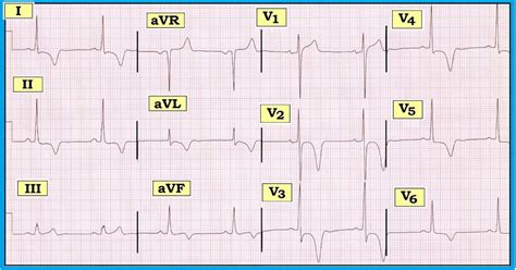 ECG Interpretation: ECG Interpretation Review #59 (T Wave Inversion – Giant T Waves – Ischemia ...