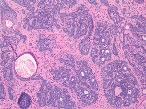 Trichoblastoma Histology