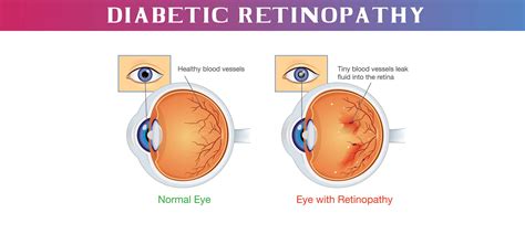 Diabetic Retinopathy causes, symptoms and Treatment-MedPlusMart