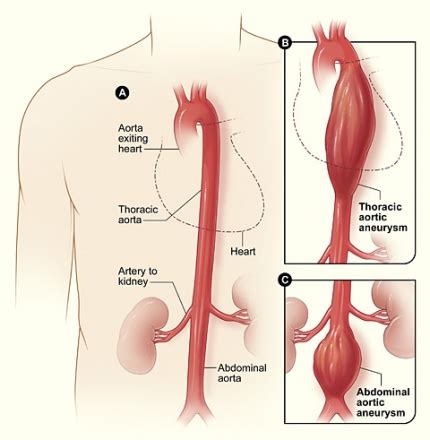 Aneurisma Aórtico Abdominal Ir para: navegação, pesquisa - CampCursos