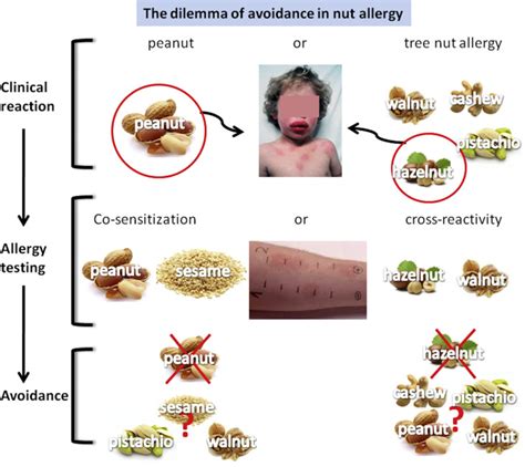 Managing Nut Allergy: A Remaining Clinical Challenge - The Journal of ...